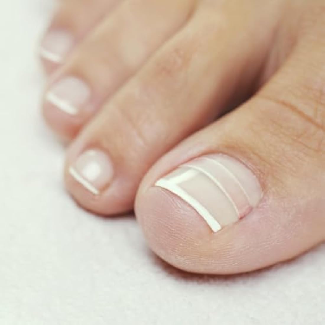 CurveCorrect Ingrown Toenail Home Treatment Kit – Nail Braces for Big Toe