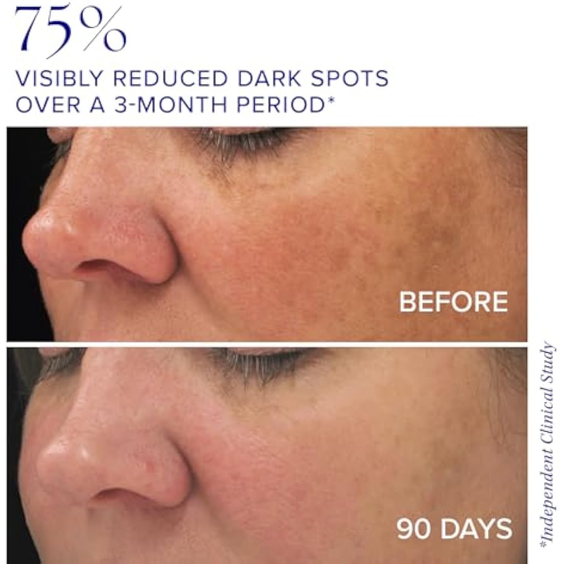 iS CLINICAL Brightening Complex – Hyperpigmentation & Age Spot Treatment