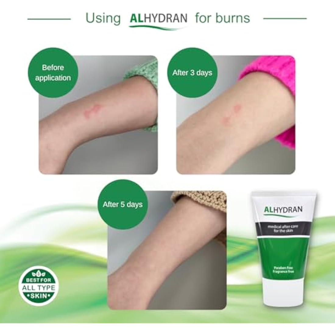 Alhydran Scar Cream | Hydrating After Care for Eczema & Burns, 30ml