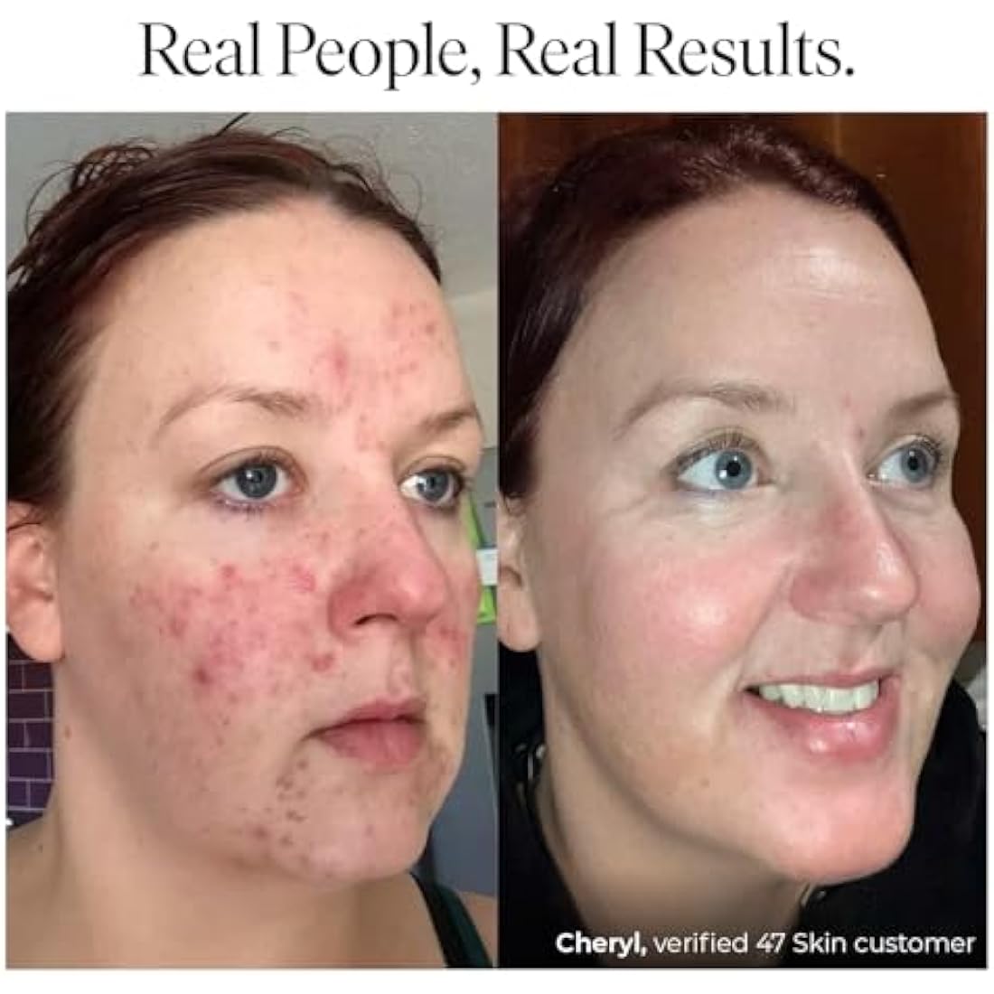 47 Skin Anti-Blemish & Scar Repair Elixir | Hyaluronic Acid & Niacinamide
