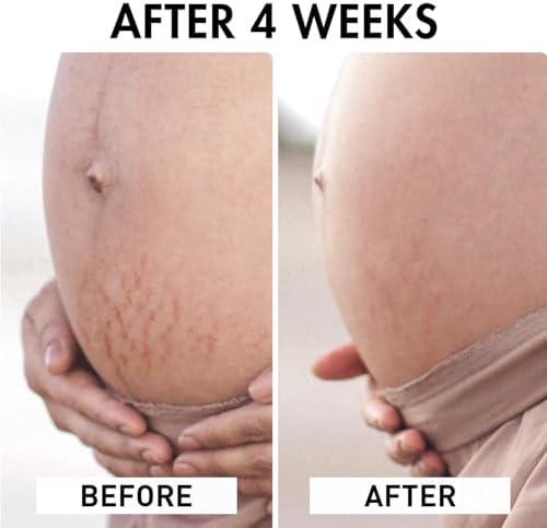 Organic Body Oil – Roll-on Stretch Mark Treatment – 100ml