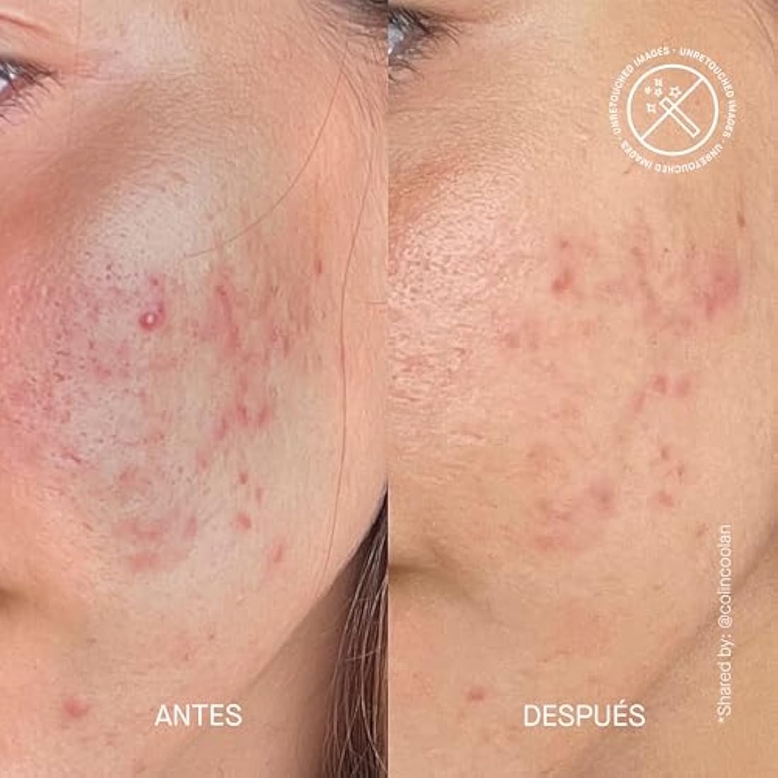 Theramid Azid 15% Azelaic Acid Treatment | Redness & Oil Control
