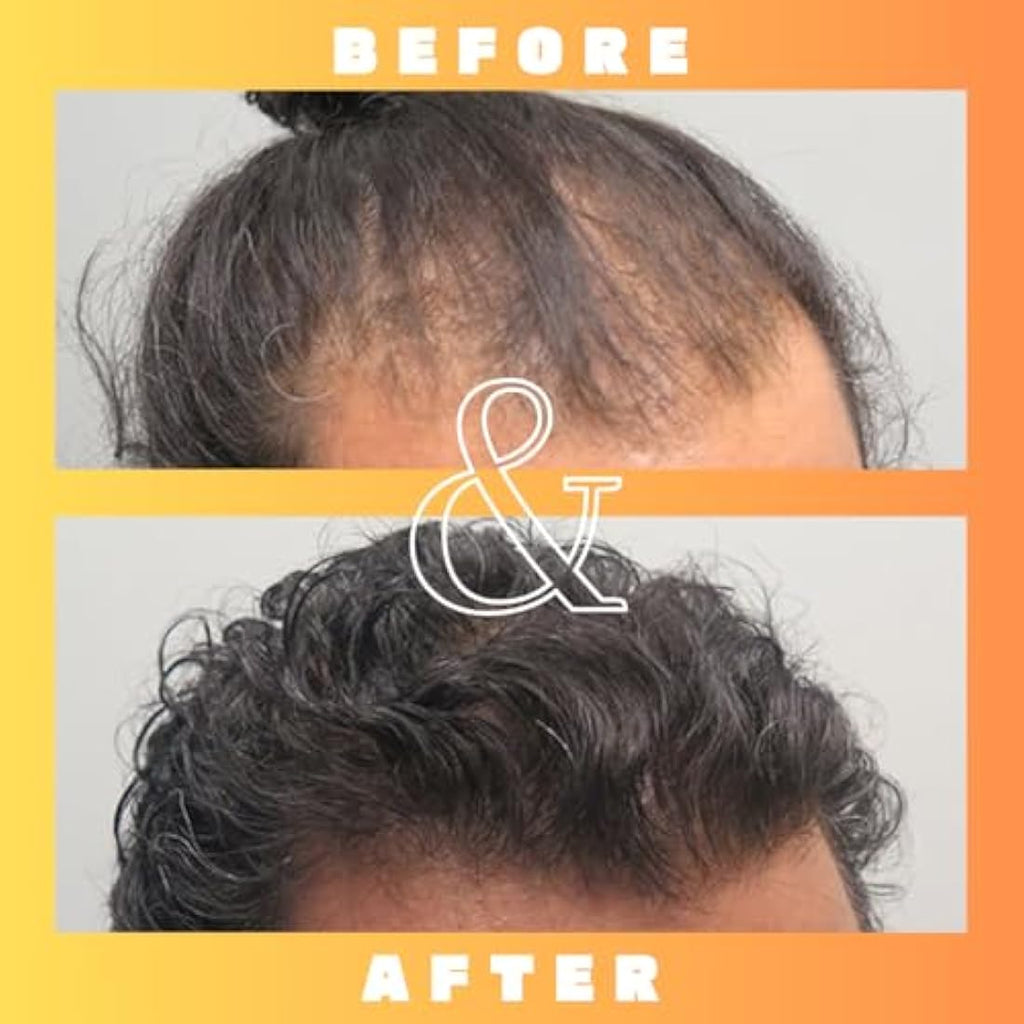 Mettle Mane RU58841 5% DHT Blocker Hair Serum – 30ml Hair Loss Solution
