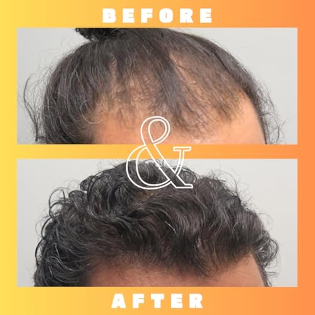 Mettle Mane RU58841 5% DHT Blocker Hair Serum – 30ml Hair Loss Solution