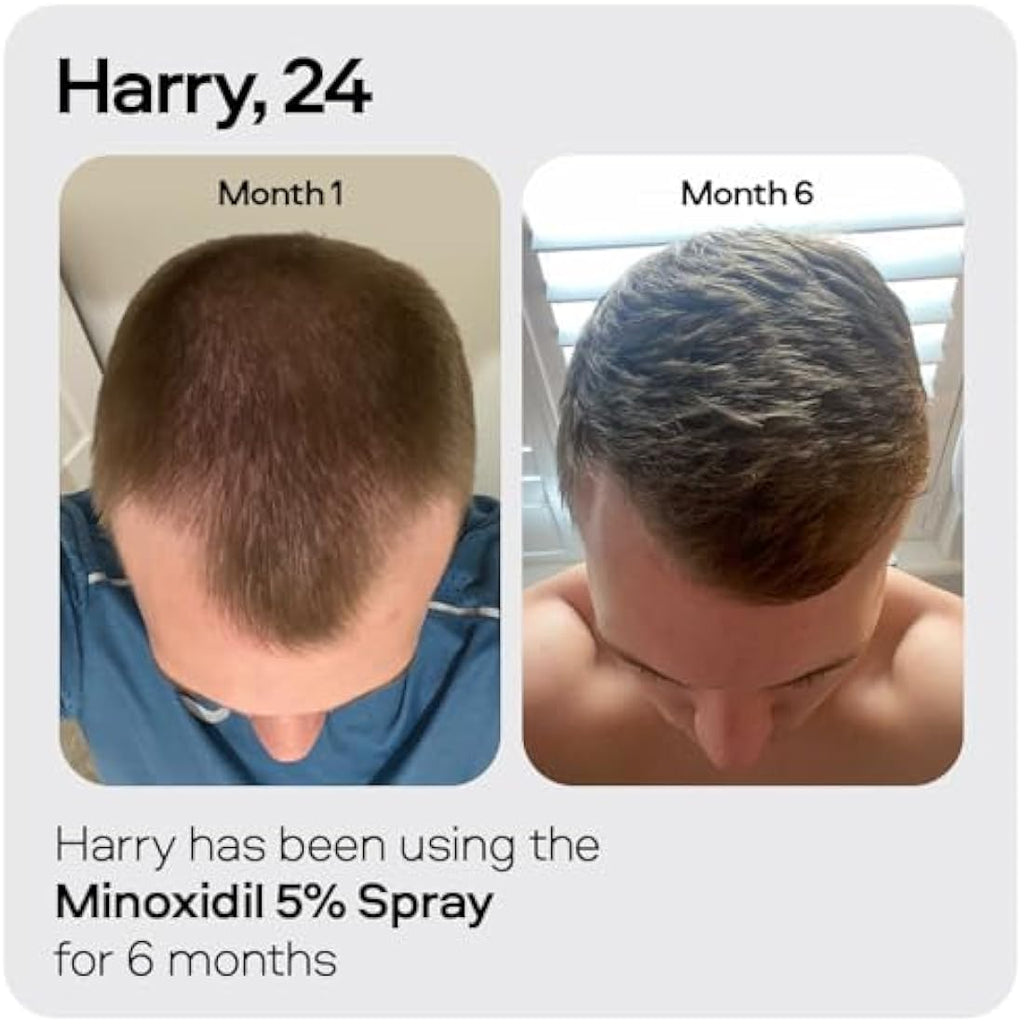 Sons Minoxidil 5% Hair Regrowth Spray for Men | 1 Month Supply (60ml)