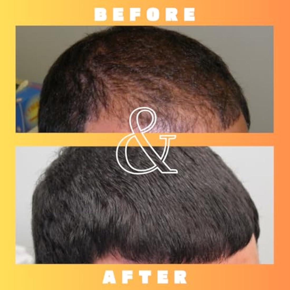 Mettle Mane RU58841 5% DHT Blocker Hair Serum – 30ml Hair Loss Solution