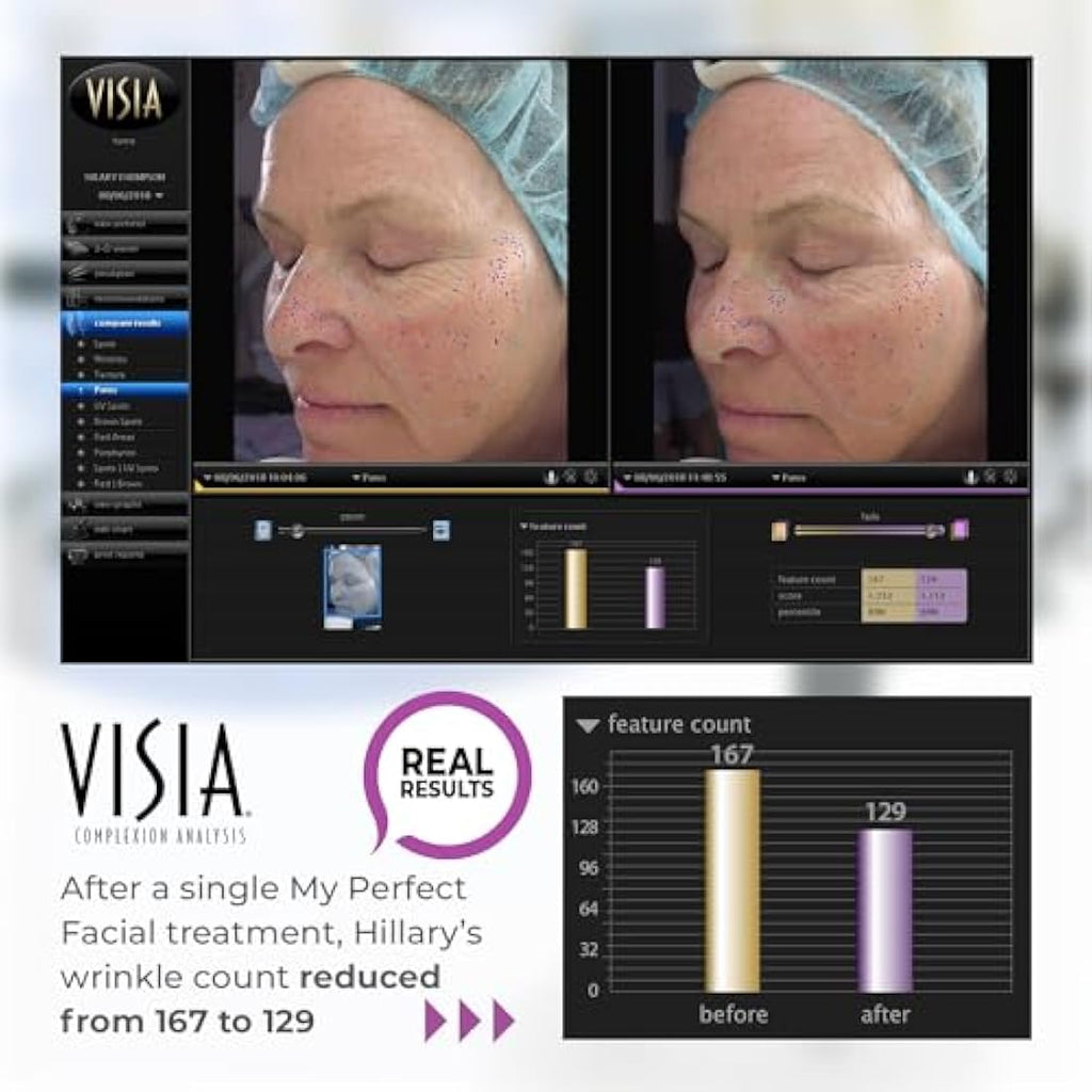 My Perfect Facial – 10 Treatment Kit – Anti-Ageing Skin Tightening System