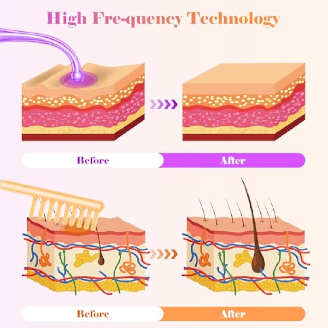 iklestar High Frequency Facial Machine | 6-Tube Hair Growth Wand Kit