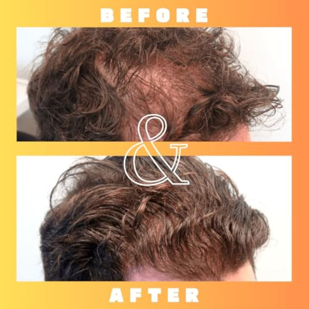 Mettle Mane RU58841 5% DHT Blocker Hair Serum – 30ml Hair Loss Solution