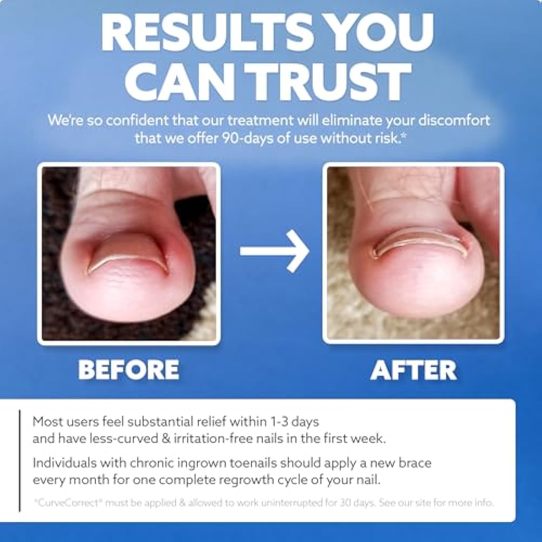 CurveCorrect Ingrown Toenail Home Treatment Kit – Nail Braces for Big Toe