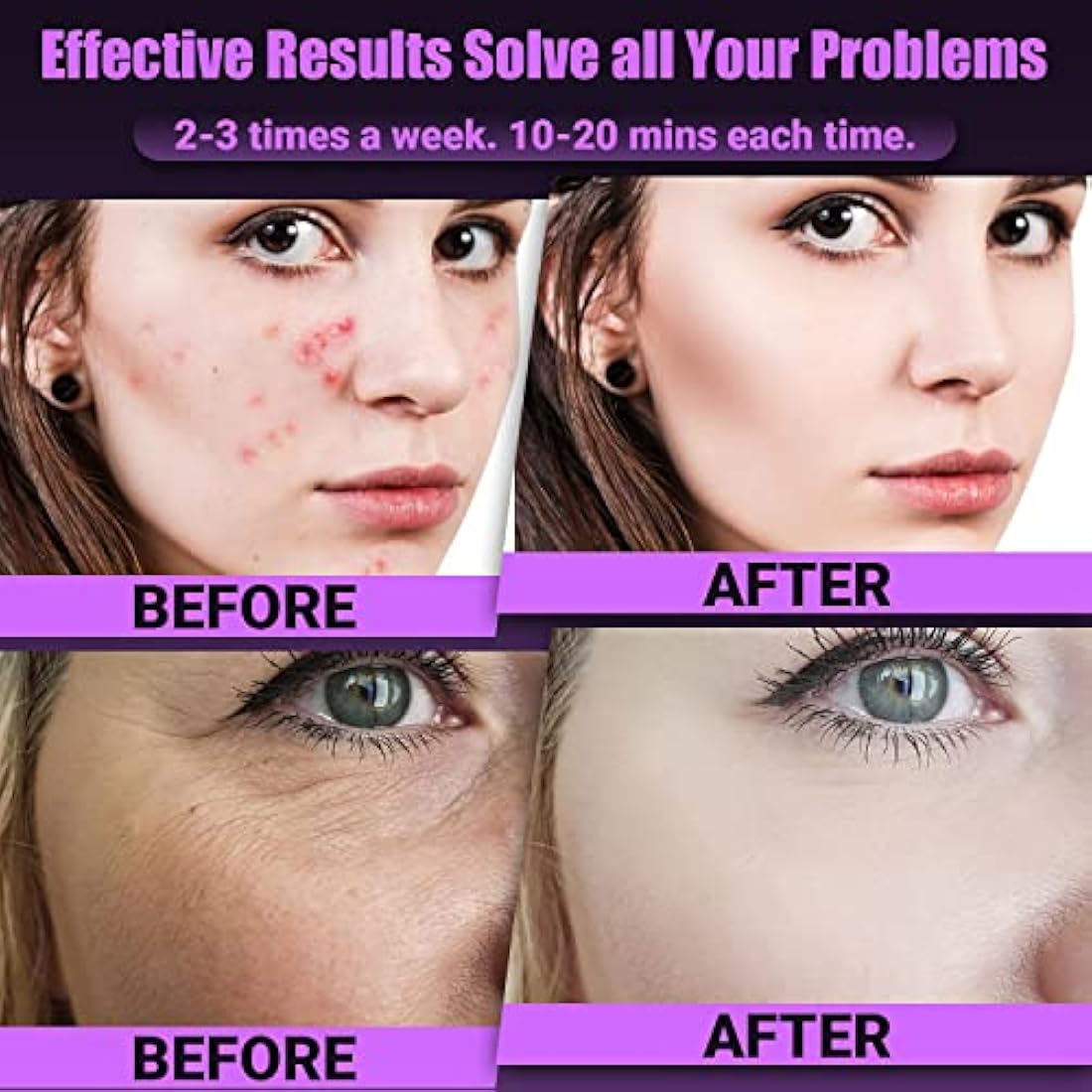 UUPAS 6-in-1 High Frequency Facial Wand | Argon Skin Tightening Device