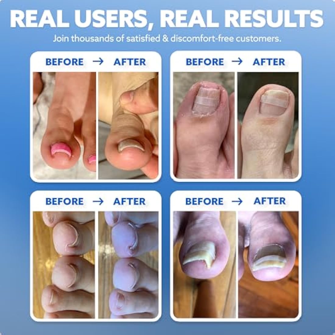 CurveCorrect Ingrown Toenail Home Treatment Kit – Nail Braces for Big Toe