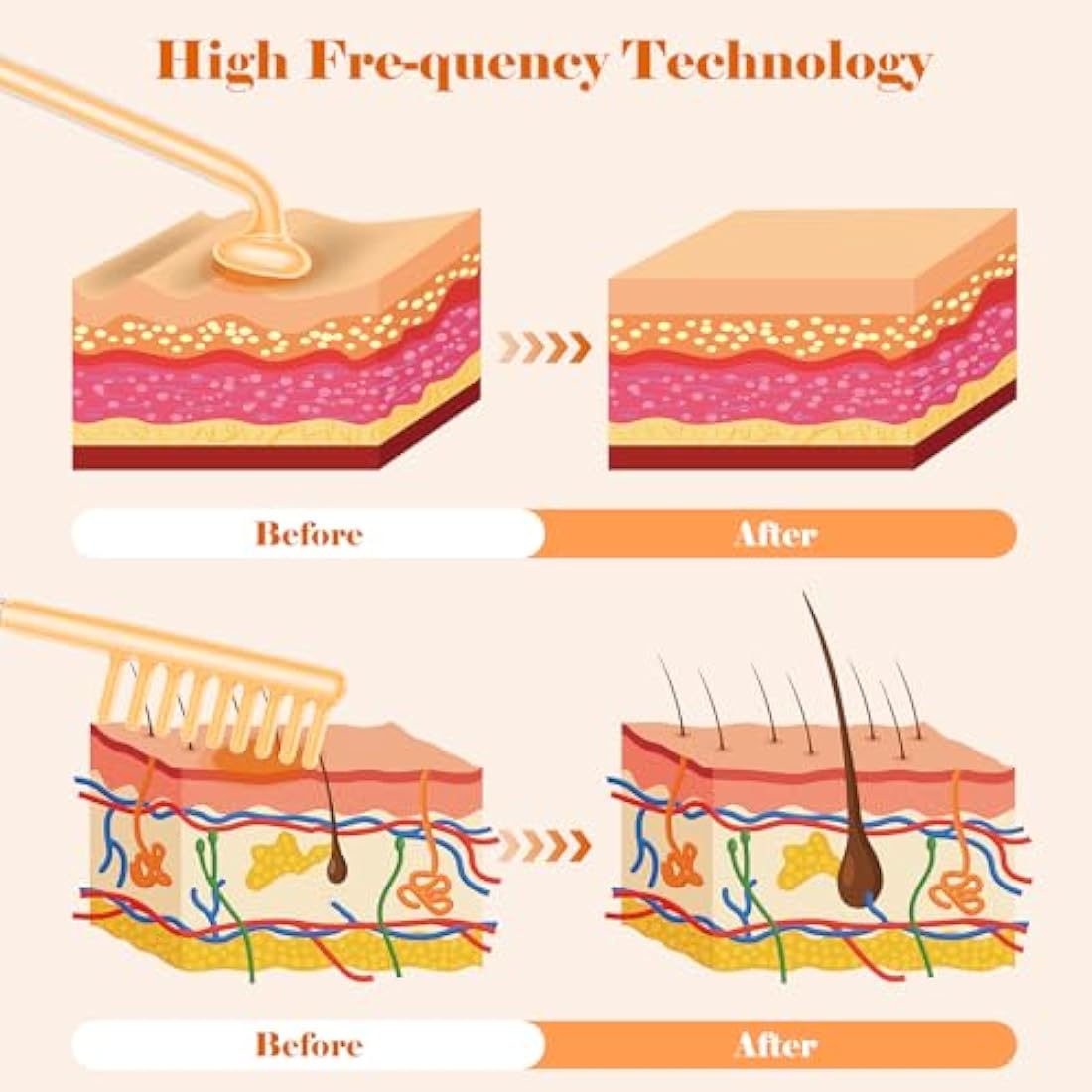 iklestar High Frequency Facial Machine Kit | 6 Tubes for Skin & Hair Growth