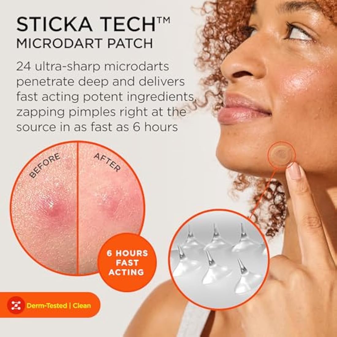 ZitSticka Killa Microdart Acne Patches for Deep Zits – 20 Count