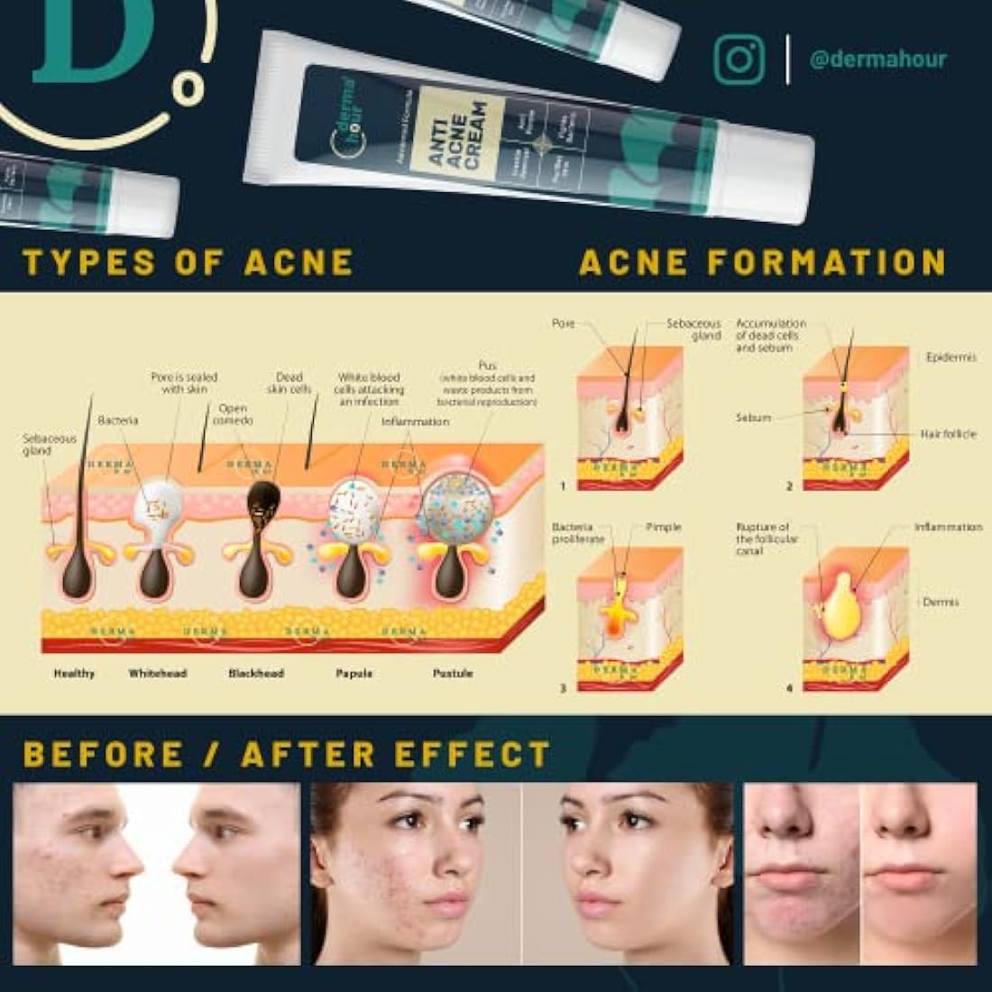 DermaHour Anti Acne Removal Cream | Oil Balancing Pore Minimizer - 40ml